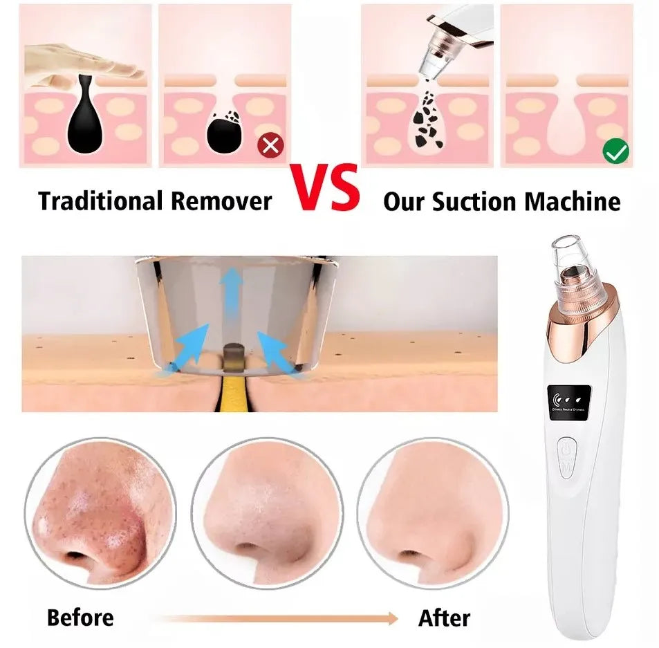 5-in-1 Blackhead Remover Machine | Rechargeable Face Vacuum