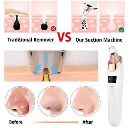 5-in-1 Blackhead Remover Machine | Rechargeable Face Vacuum